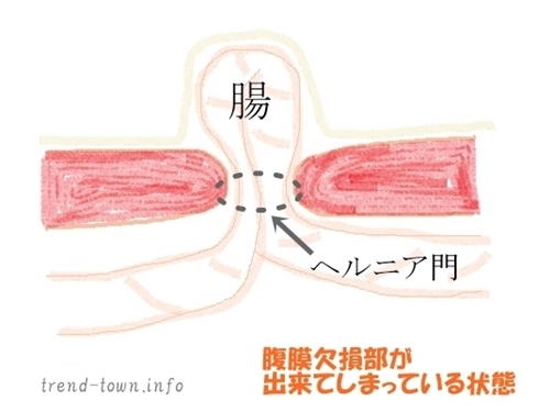 臍ヘルニア13